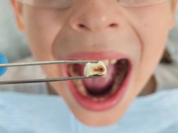 Best Emergency Tooth Extraction in Paia, HI